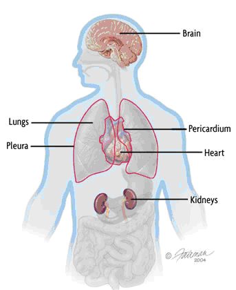 Systemic Lupus Erythematosus (SLE): A Guide for Patients – Malaysian ...